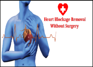 blockage arteries blocked challenging severely